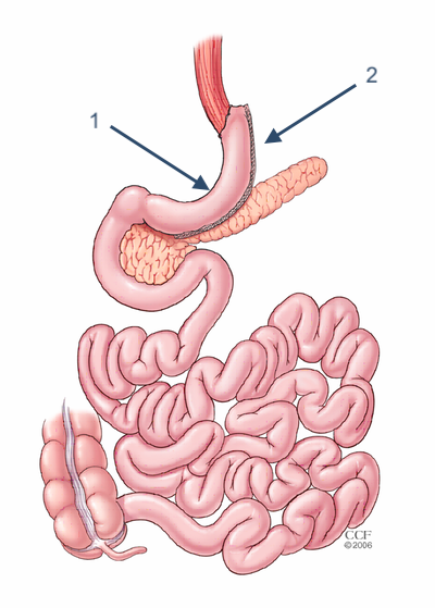 gastric-sleeve