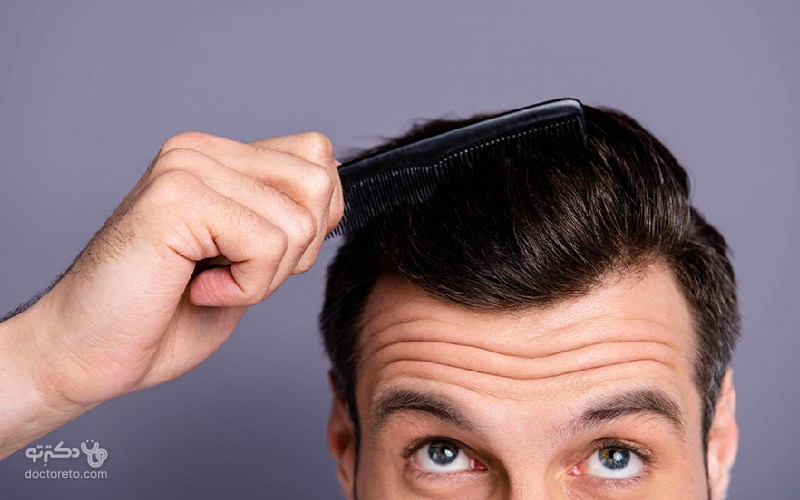 ماندگاری پروتز مو چقدر است؟