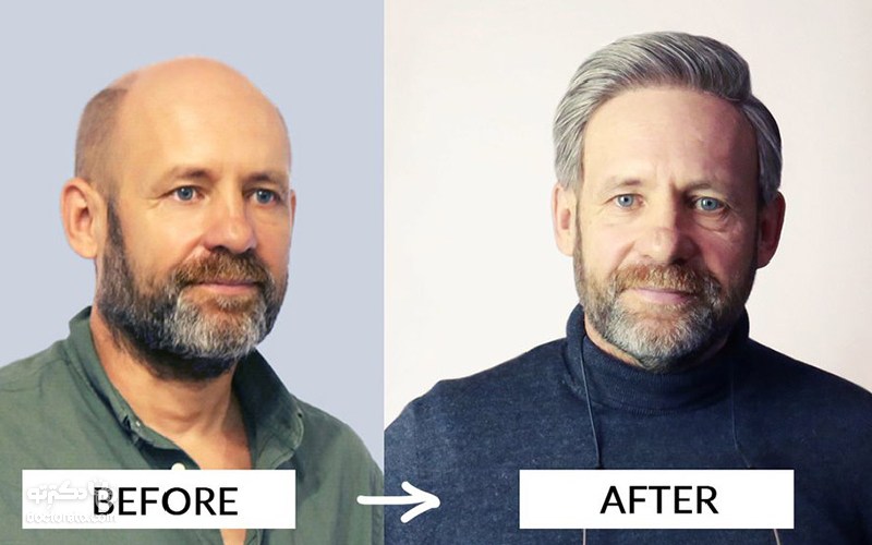 قبل و بعد پروتز مو چه فرقی دارد؟