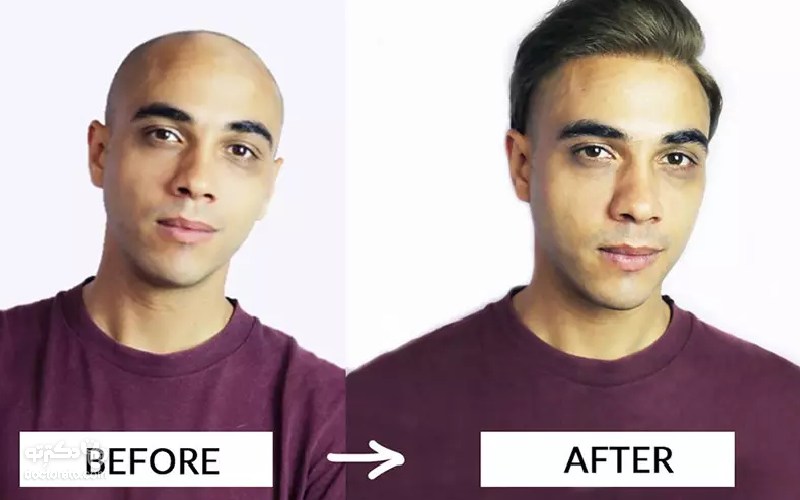 قبل و بعد پروتز مو چگونه است؟