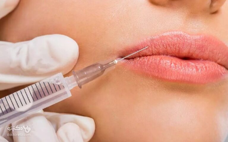 ژل لب عروسکی و عکس آن، مزایا و نحوه تزریق ژل لب عروسکی