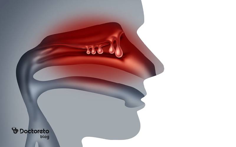 پولیپ بیننی چیست؟