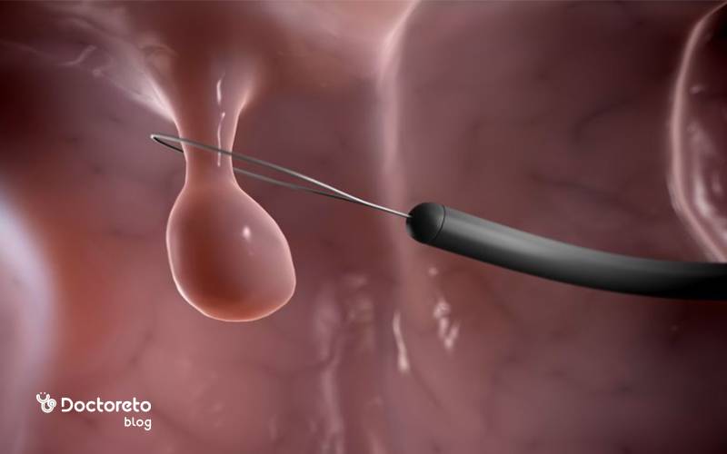 جراحی پولیپ بیننی