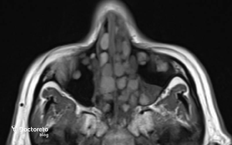 از کجا بفهمیم پولیپ بینی داریم؟