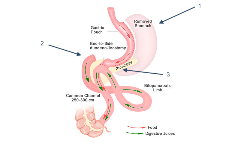gastric-sleeve