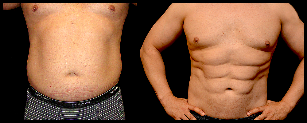 six-pack-surgery