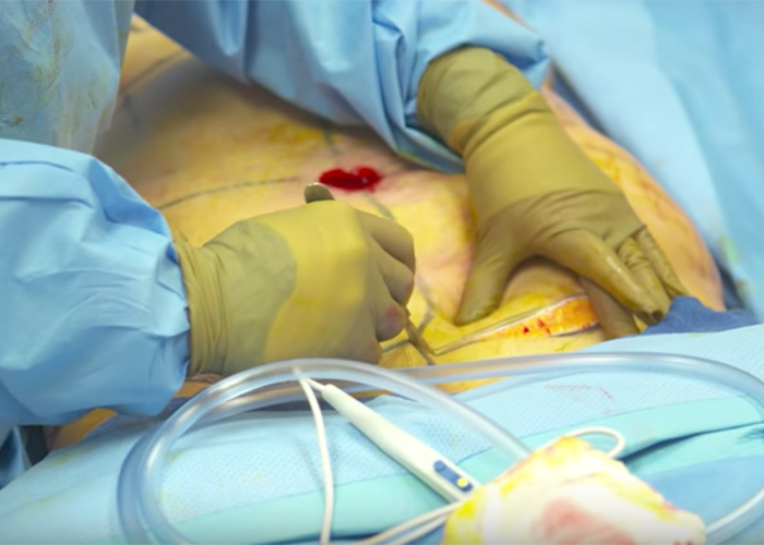 abdominoplasty