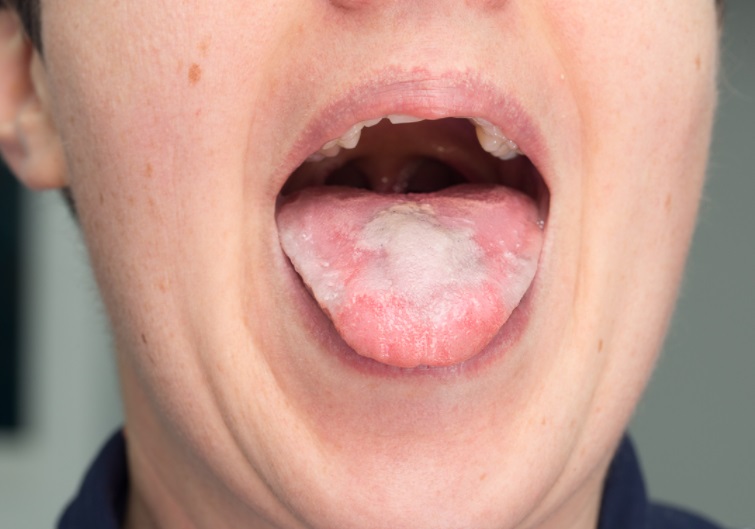 انواع سرطان زبان و دهان