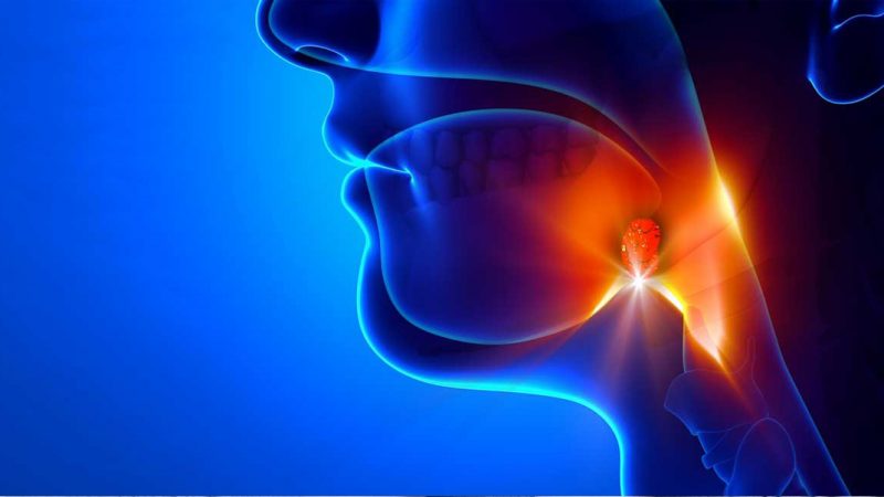 throat-cancer