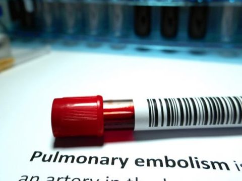 Pulmonary-embolism