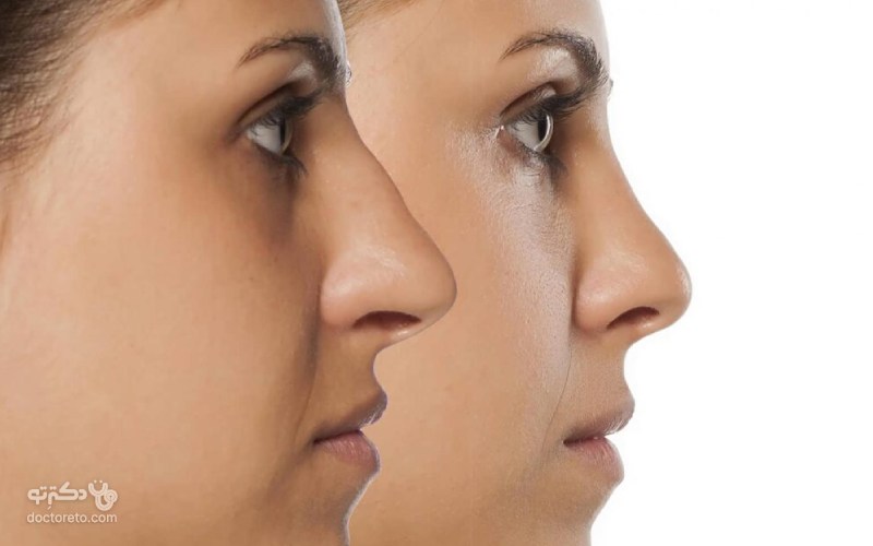 عکس عمل بینی استخوانی