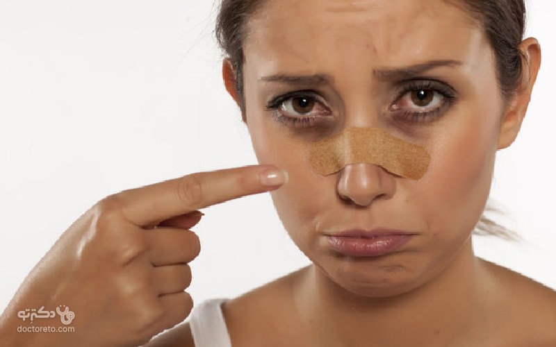 جراحی بینی و کبودی