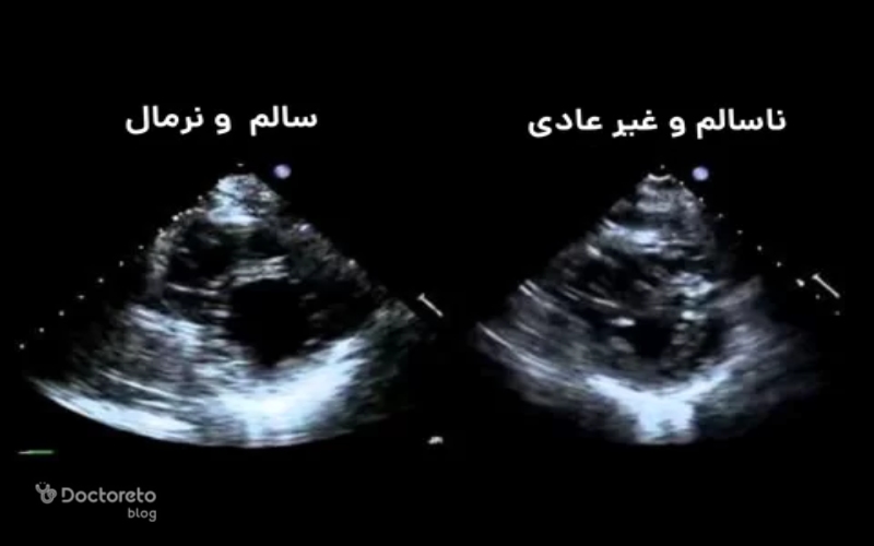 تصویر اکو قلب سالم در کنار تصویر اکو قلب ناسالم