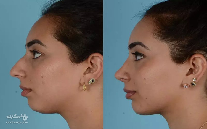 عکس عمل بینی
