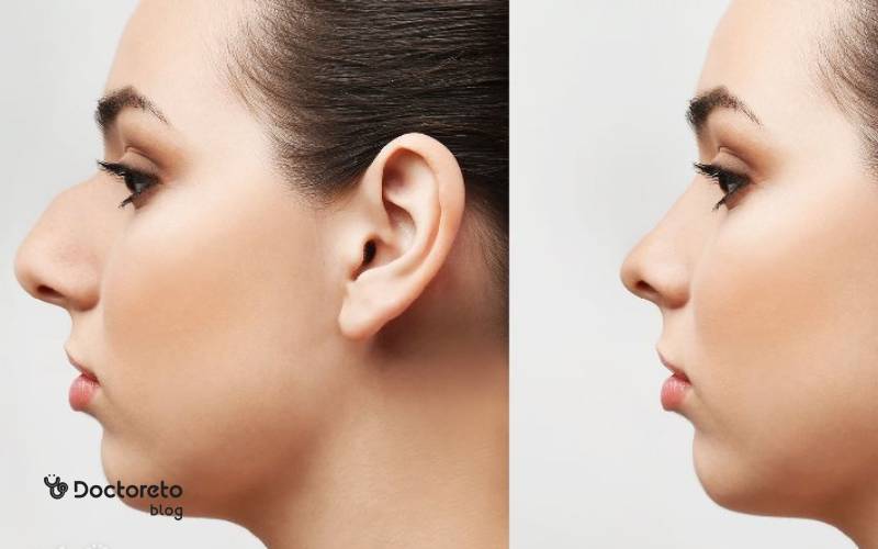 انواع عمل زیبایی بینی