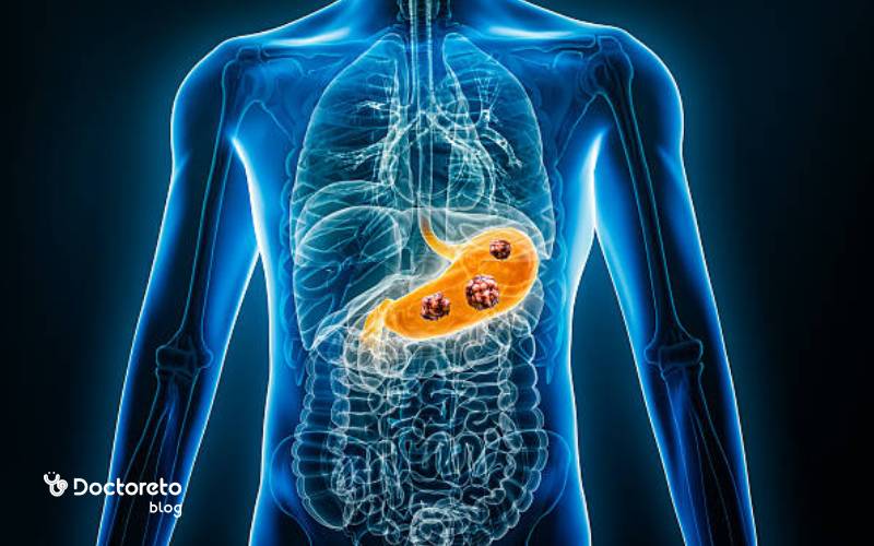 کارسینوئید معده