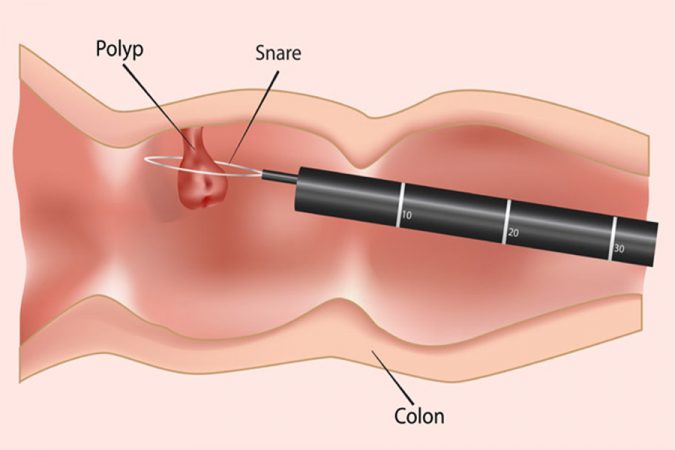 cure-intestinal-cancer