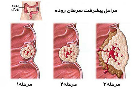 مراحل سرطان روده بزرگ مختلف هستند.