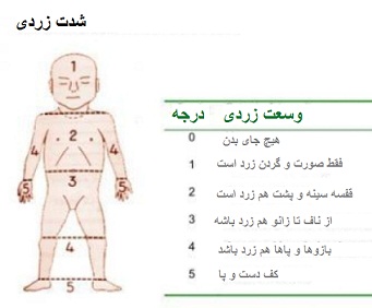 درجه-زردی-نوزاد