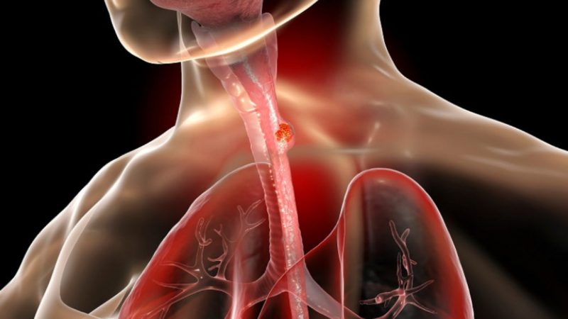 درمان-سرطان-مری