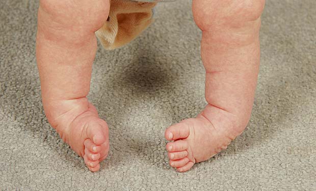 پاهای نوزادان را در سنین پایین باید درمان کرد. 