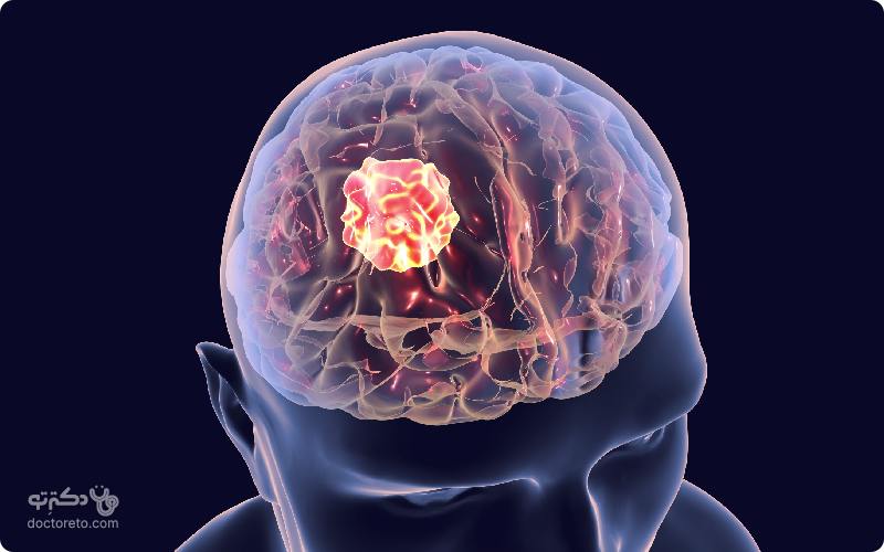 انواع تومور مغزی و علائم و راه های درمان سرطان مغز چیست؟