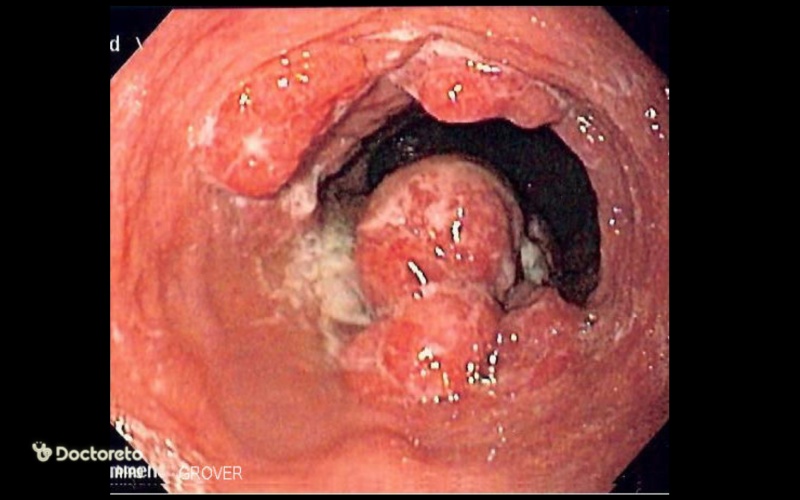 عکس سرطان مری