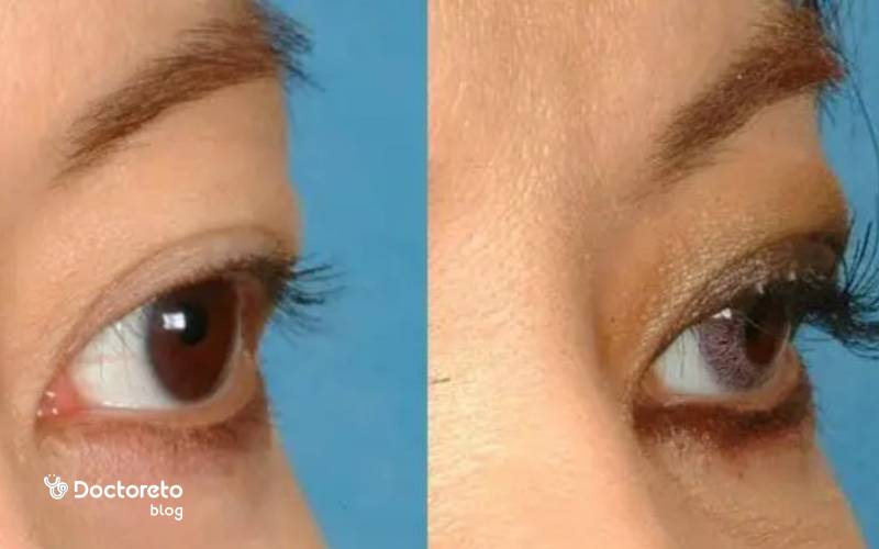 عکس قبل و بعد کاشت مژه طبیعی