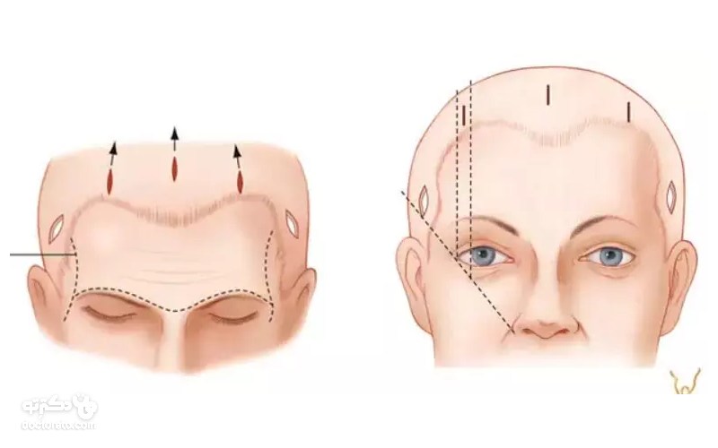 روش های مختلفی برای لیفت پیشانی و صورت وجود درد