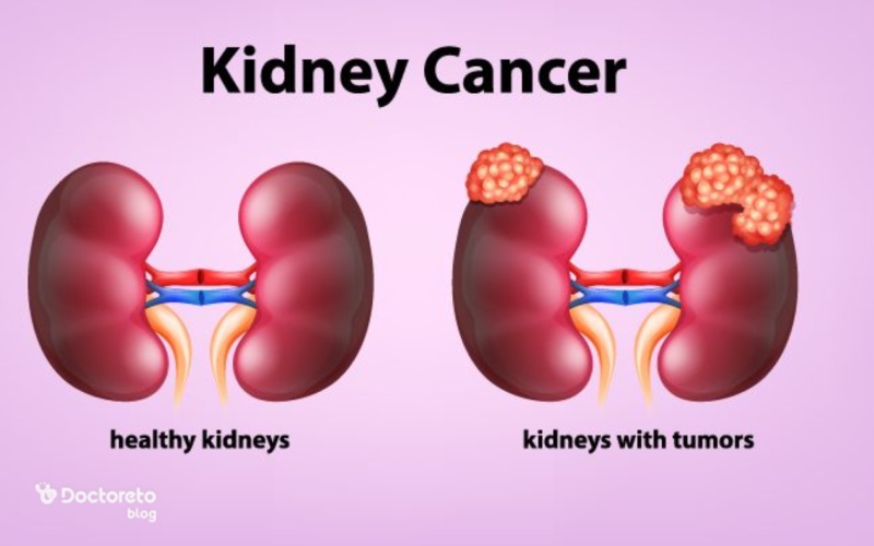 دلایل ابتلا به سرطان کلیه چیست؟