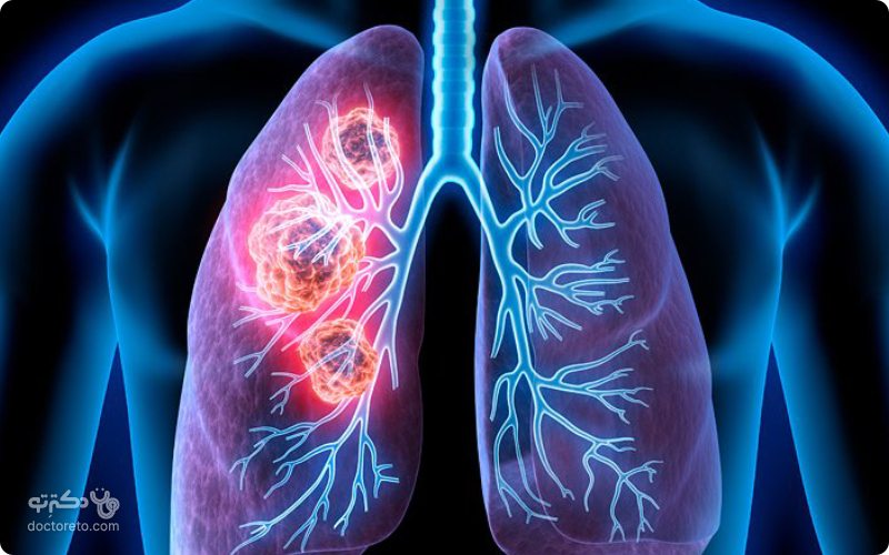 علائم سرطان ریه چیست و چگونه درمان می شود؟