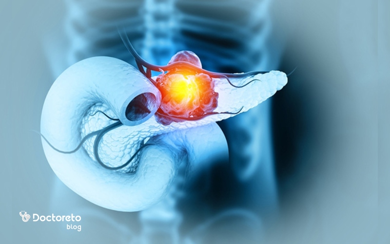 علائم سرطان پانکراس و راه های درمان سرطان لوزالمعده چیست؟