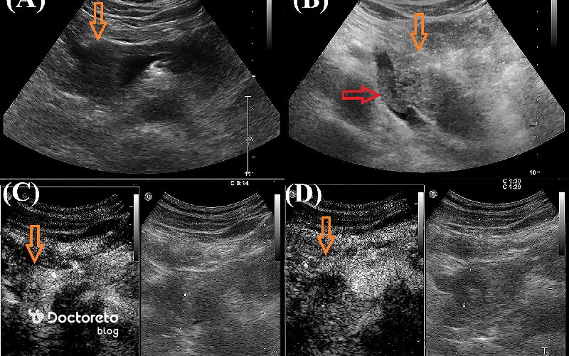 تشخیص سرطان پانکراس با سونوگرافی