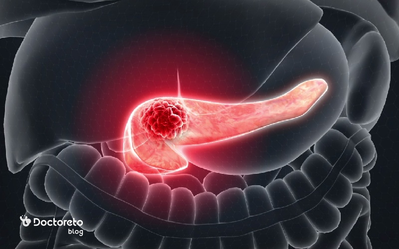 علت سرطان پانکراس چیست؟ (علت سرطان لوزالمعده)