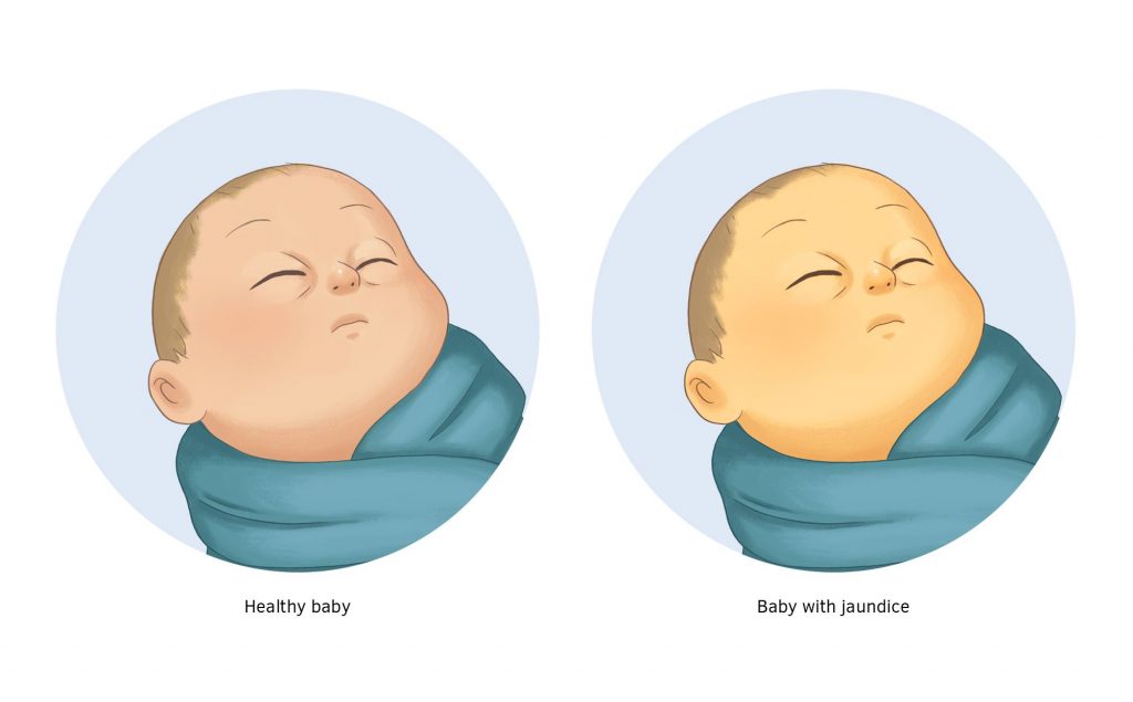 jaundice_in_newborn_babies