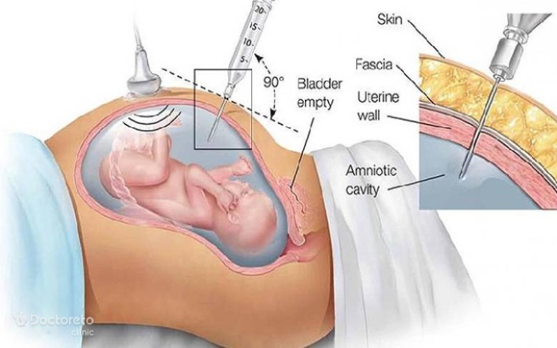 آزمایش آمنیوسنتز در بارداری
