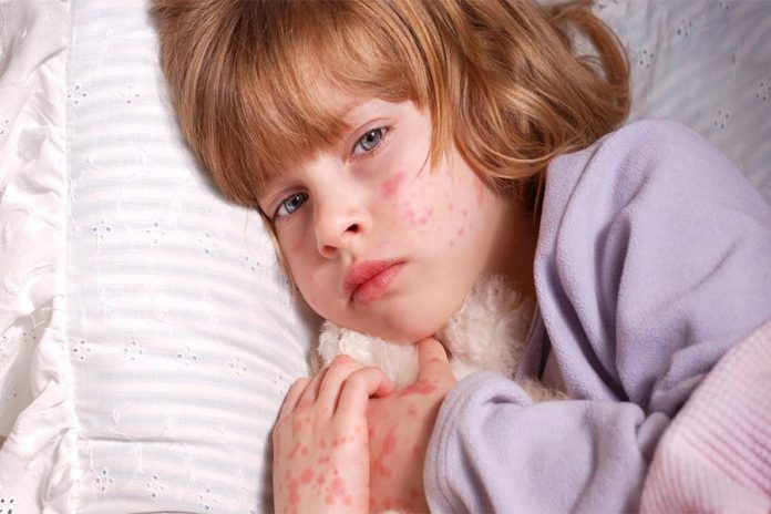 skin-allergies-children