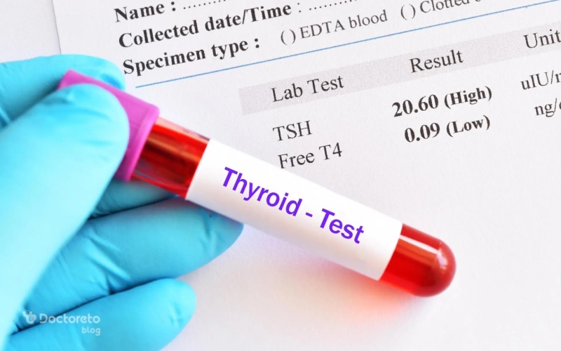 راهنمای خواندن آزمایش تیروئید (TSH) و تفسیر نتیجه آن