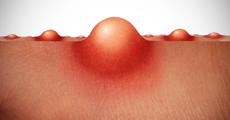 vaginal-pimples