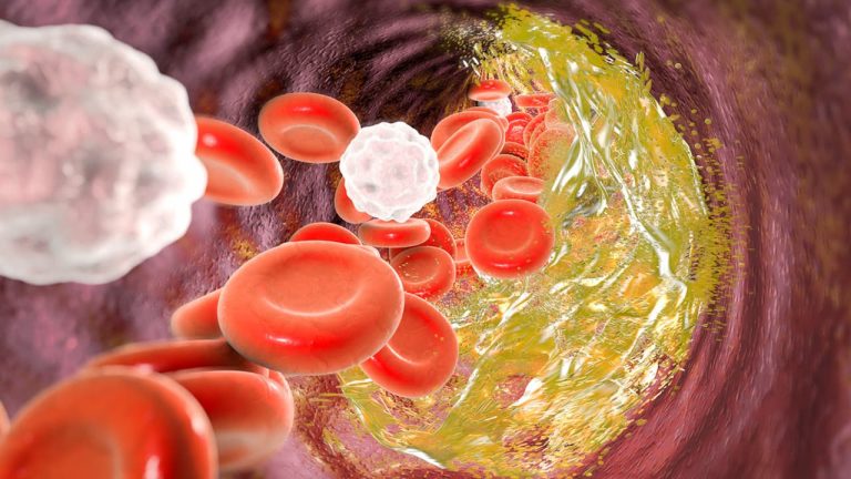 Atherosclerosis