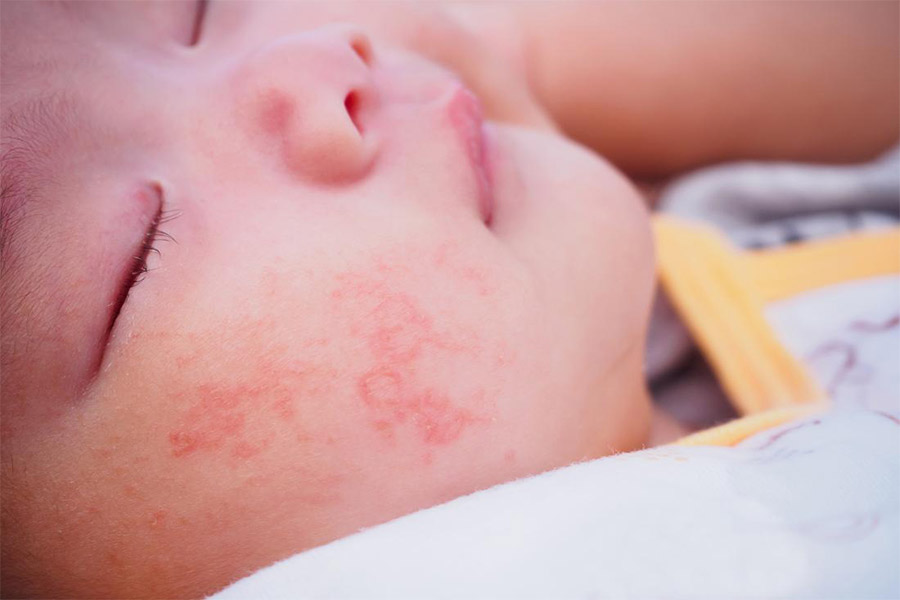 حساسیت پوستی اگزما در کودکان و نوزادان