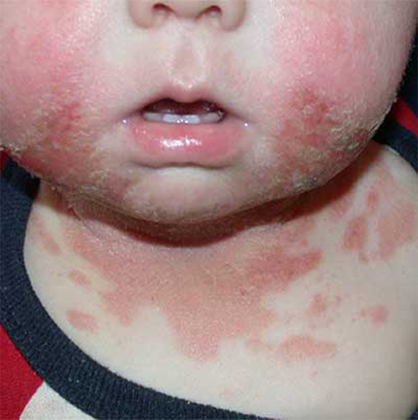 تصویر حساسیت پوستی کودک از نوع درماتیت تماسی