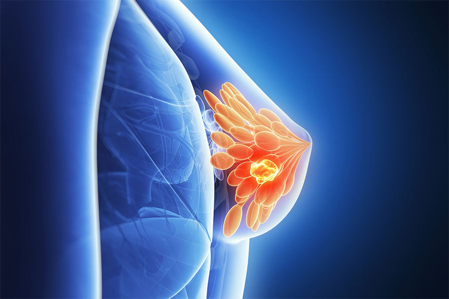 توده سرطانی در سینه می‌تواند خوش خیم و یا بد خیم باشد. 