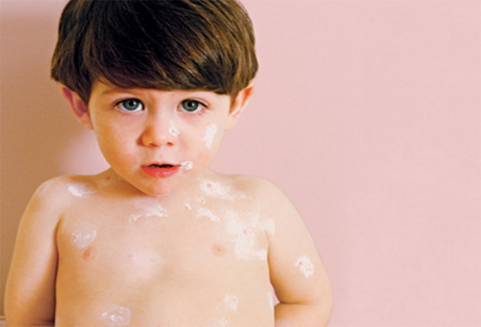 کرم اگزاسین کودک و درمان حساسیت پوستی