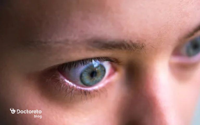 همه چیز درباره تیروئید چشمی؛ علل و علائم تیروئید چشمی
