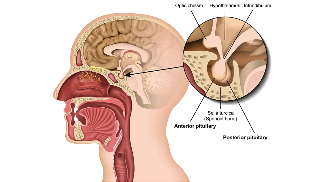 Enlargement-of-the-pituitary-gland
