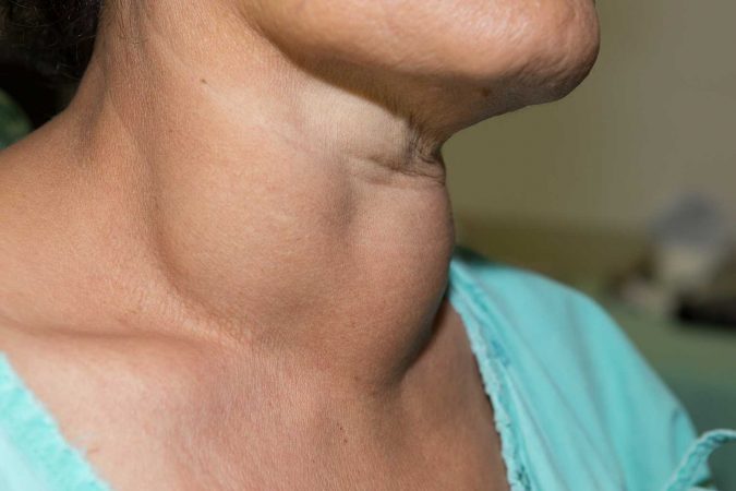 thyroid-disease