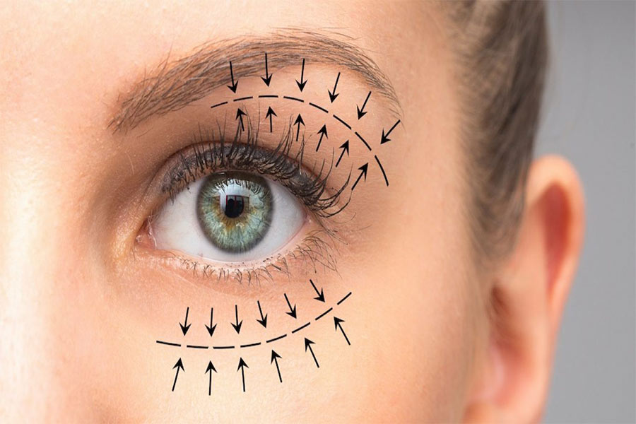 عمل چشم گربه ای یا کانتوپلاستی چیست؟ نحوه انجام این جراحی زیبایی و عوارض آن
