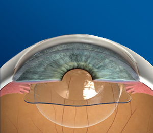 RLE-eye-surgeries