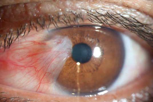 eye-surgeries